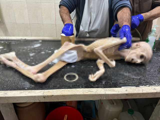 Gazze'de yeterli beslenemeyen 10 yaşındaki çocuk bir deri bir kemik halde öldü